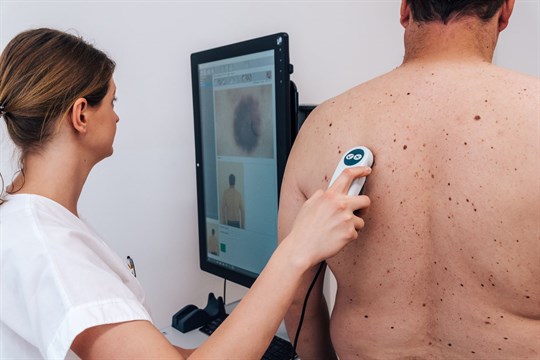 Den melanomu nabídne preventivní vyšetření kůže zdarma a bez objednání